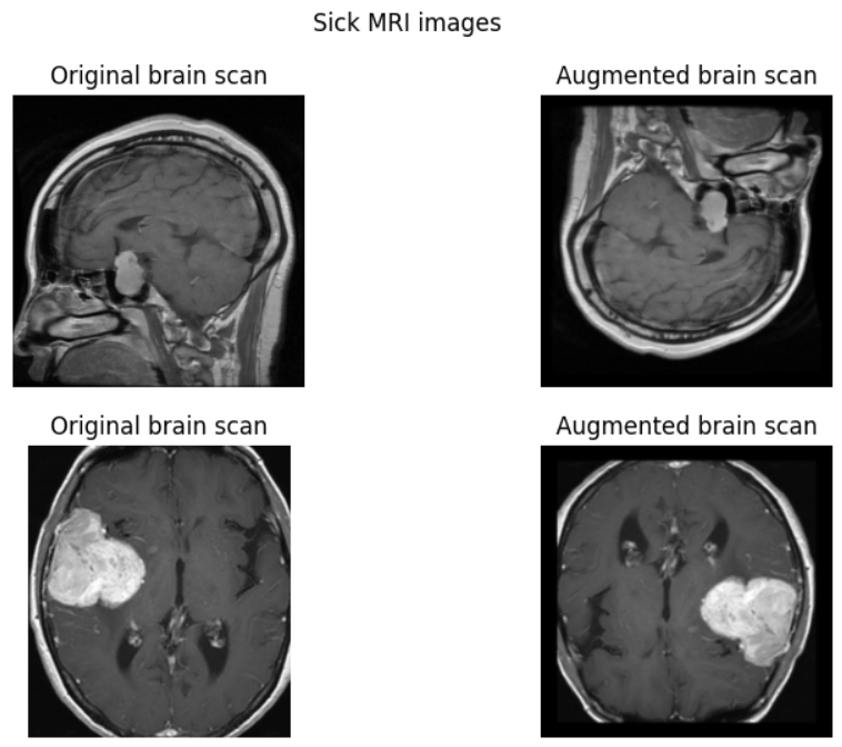 Brain Tumor Image